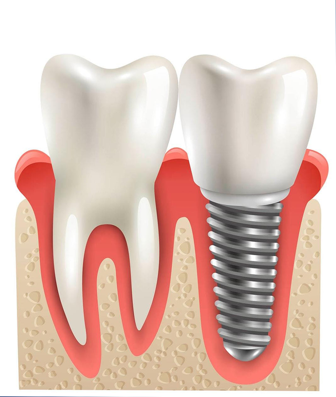 Основные преимущества имплантации зубов