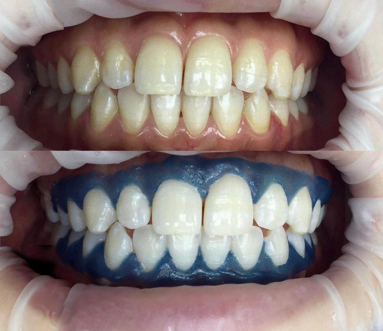 Белоснежная улыбка: польза профессионального отбеливания зубов